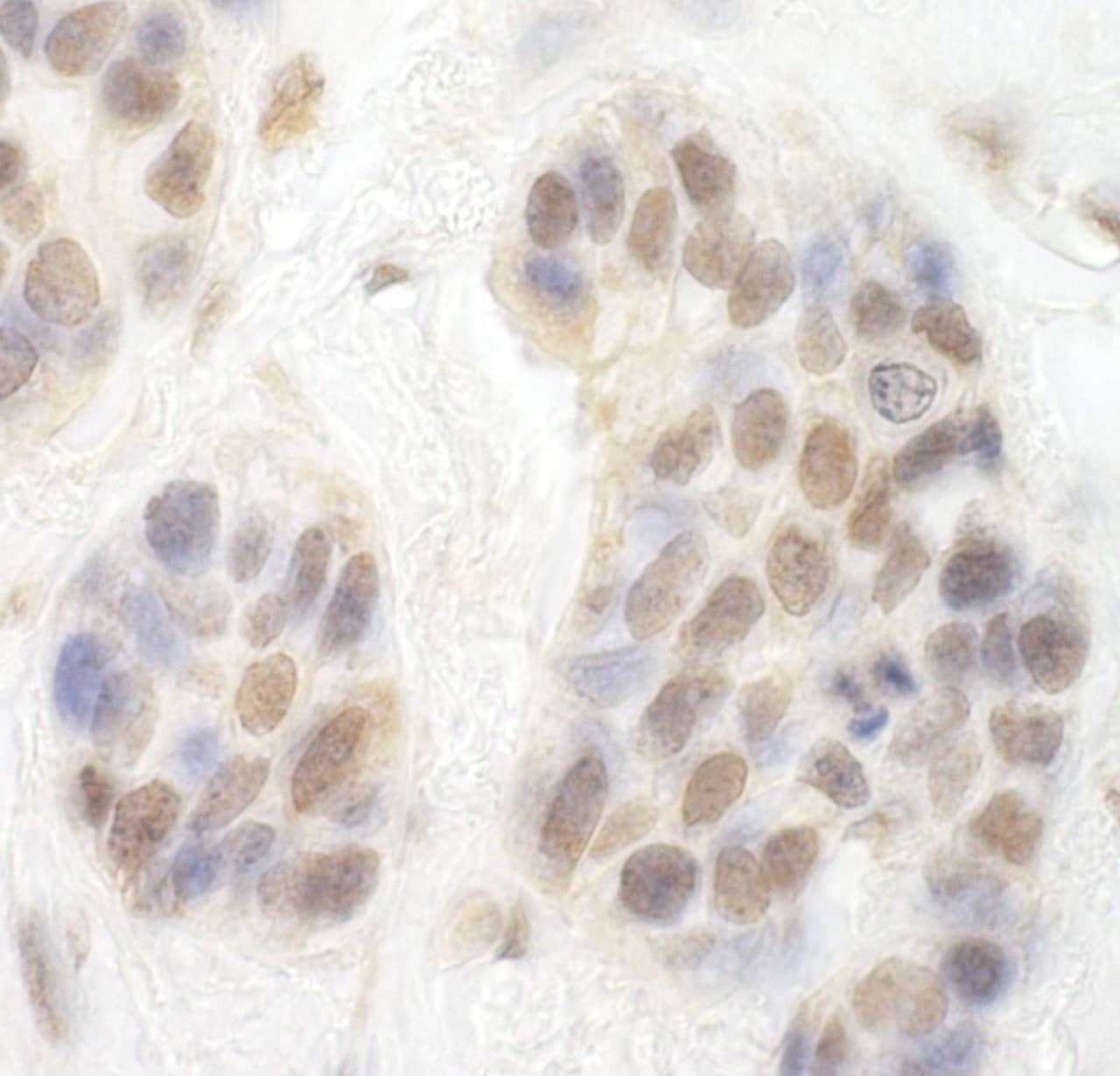 Immunohistochemistry:[NBP3-30342]-Detection of human CDK8 by immunohistochemistry. Sample: FFPE section of human breast carcinoma. Antibody: Affinity purified rabbit anti-CDK8 used at a dilution of 1: 200. Detection: DAB