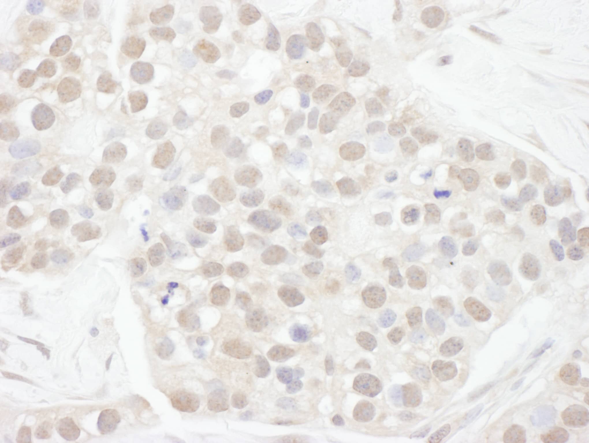 Immunohistochemistry:[NBP3-30368]-Detection of human Cyclin T1 by immunohistochemistry. Sample: FFPE section of human breast carcinoma. Antibody: Affinity purified rabbit anti-Cyclin T1 used at a dilution of 1: 200. Detection: DAB