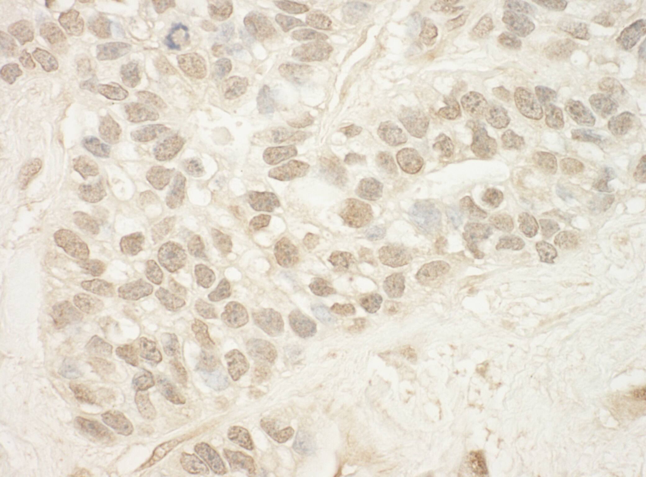 Immunohistochemistry:[NBP3-30370]-Detection of human MED15 by immunohistochemistry. Sample: FFPE section of human breast carcinoma. Antibody: Affinity purified rabbit anti-MED15 used at a dilution of 1: 200. Detection: DAB