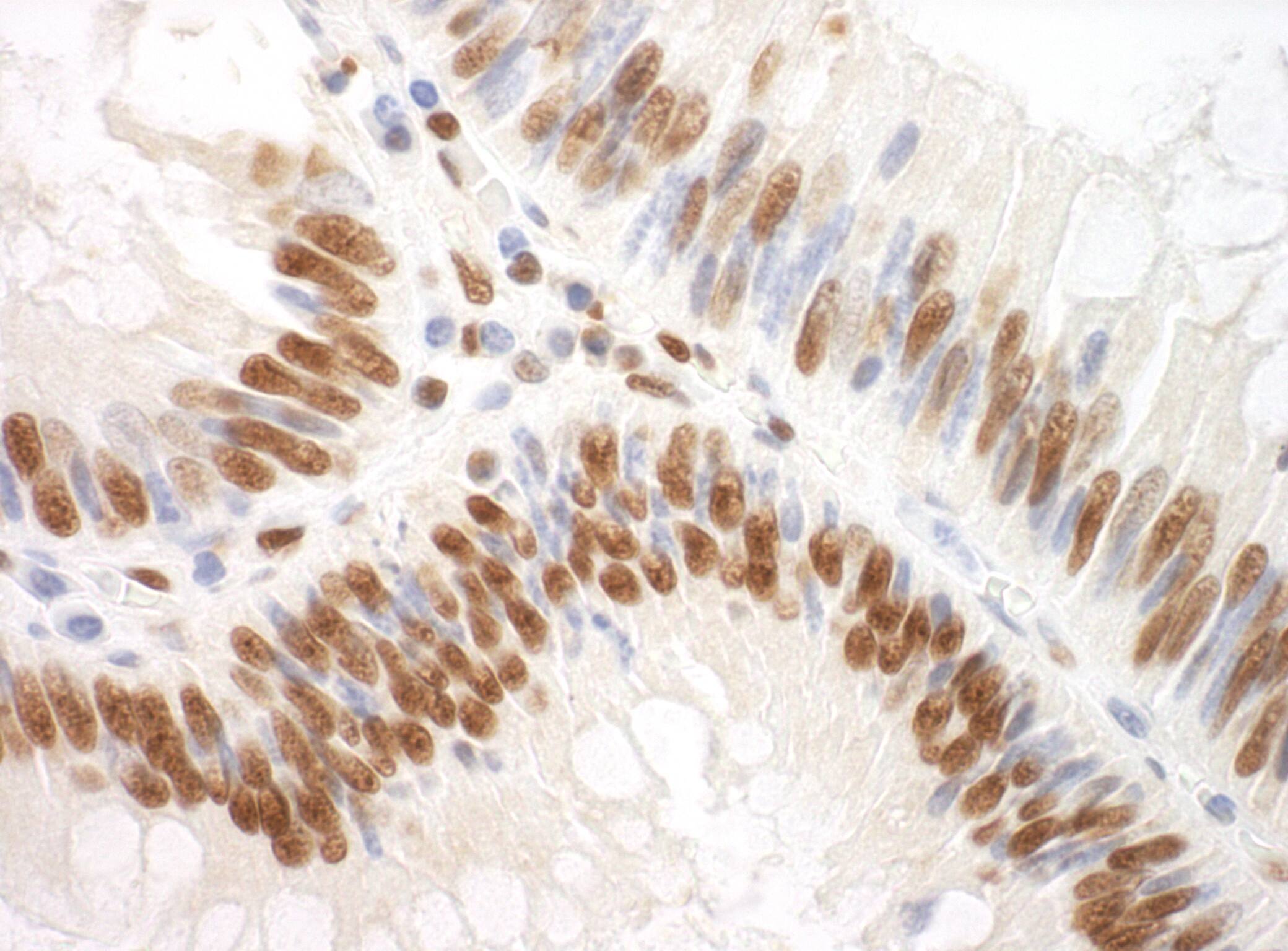 Immunohistochemistry:[NBP3-30390]-Detection of human SF3A3 by immunohistochemistry. Sample: FFPE section of human colon carcinoma. Antibody: Affinity purified rabbit anti-SF3A3 used at a dilution of 1: 200. Detection: DAB