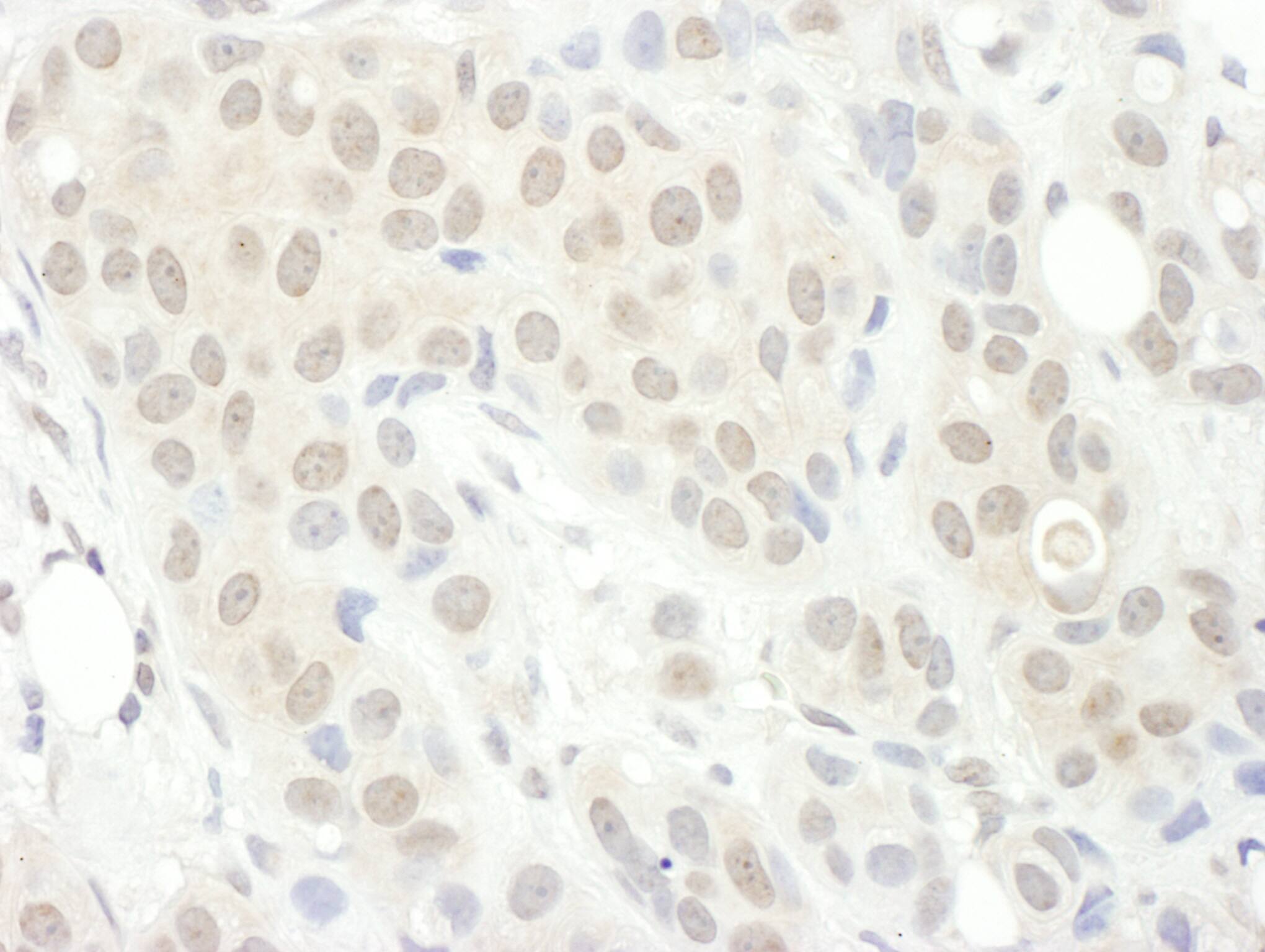 Immunohistochemistry;PPP2R5C Antibody[NBP3-30391]Detection of human PPP2R5C by immunohistochemistry. Sample: FFPE section of human breast carcinoma. Antibody: Affinity purified rabbit anti-PPP2R5C  used at a dilution of 1:1,000 . Detection: DAB. Counterstain: Hematoxylin .
