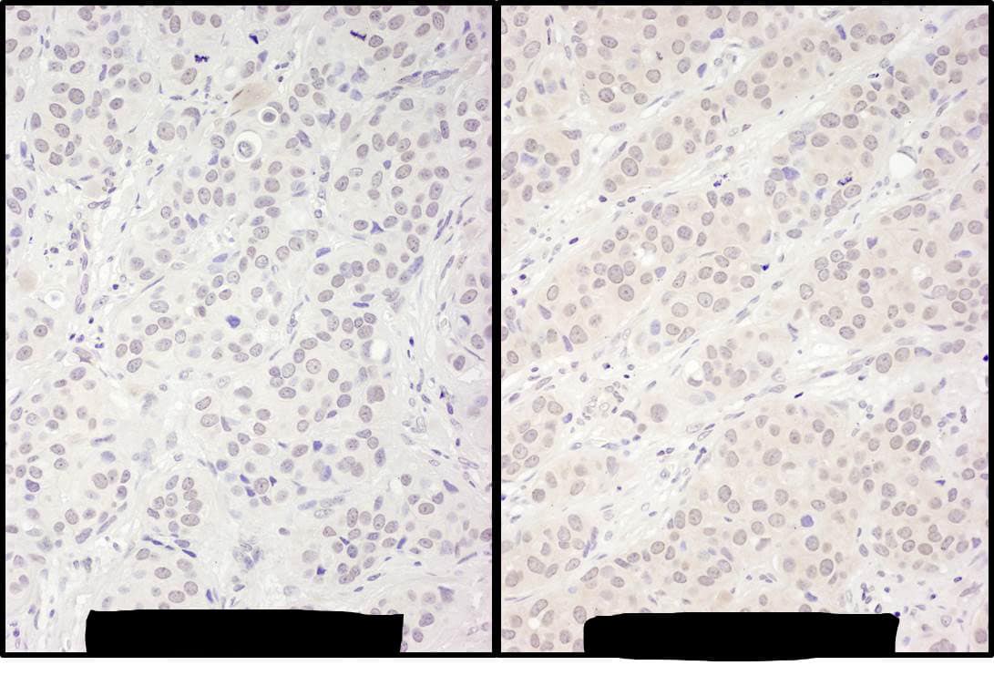 Immunohistochemistry:[NBP3-30417]-Detection of human DDX56 by immunohistochemistry. Samples: FFPE serial sections of human breast carcinoma. Antibody: Affinity purified rabbit anti-DDX56 used at a dilution of 1: 1,000. Detection: DAB