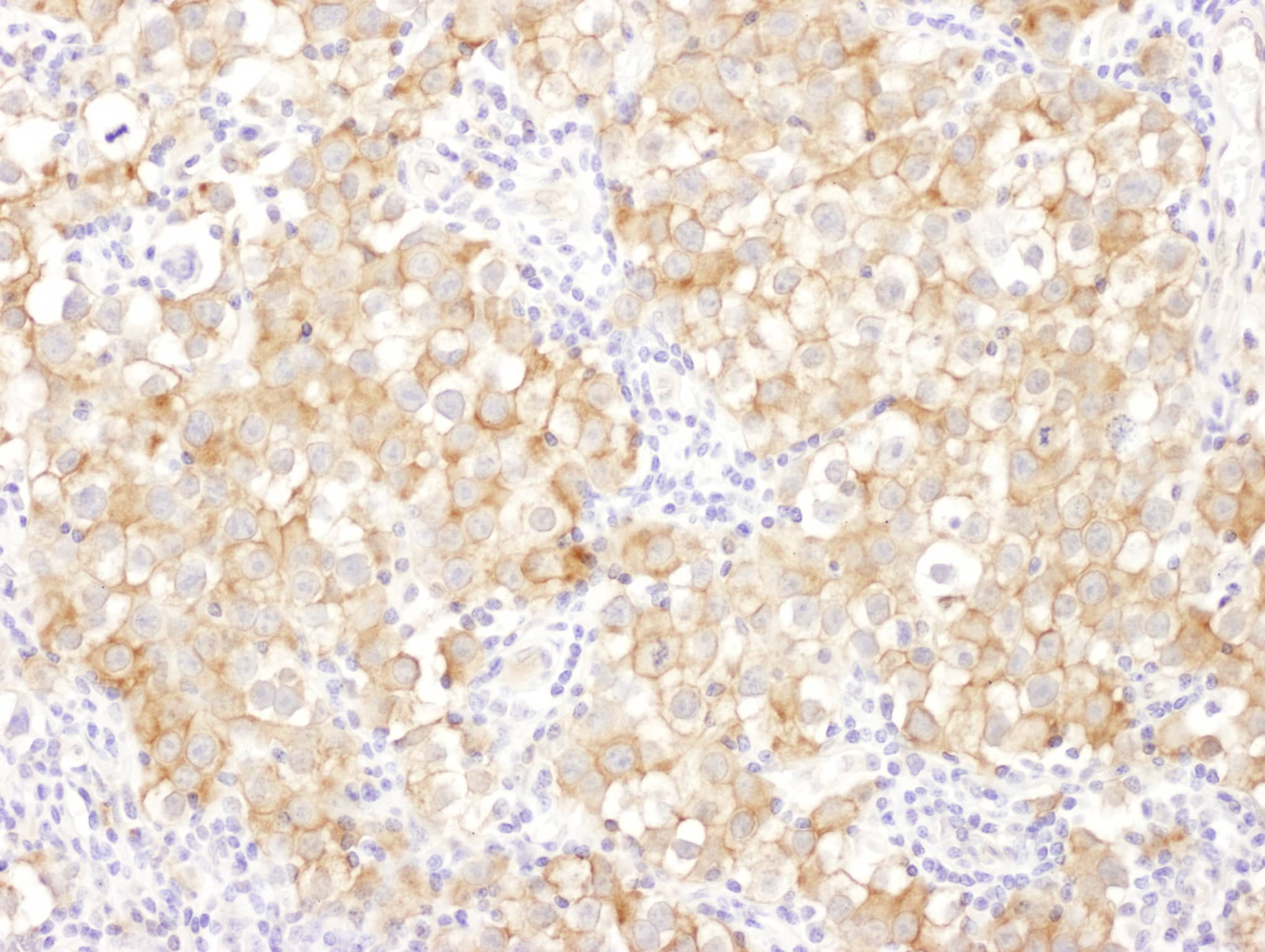 Immunohistochemistry;Drebrin 1 Antibody[NBP3-30417]Detection of human Drebrin by immunohistochemistry. Sample: FFPE section of human ovarian carcinoma. Antibody: Affinity purified rabbit anti-Drebrin  used at a dilution of 1:1,000 . Detection: DAB