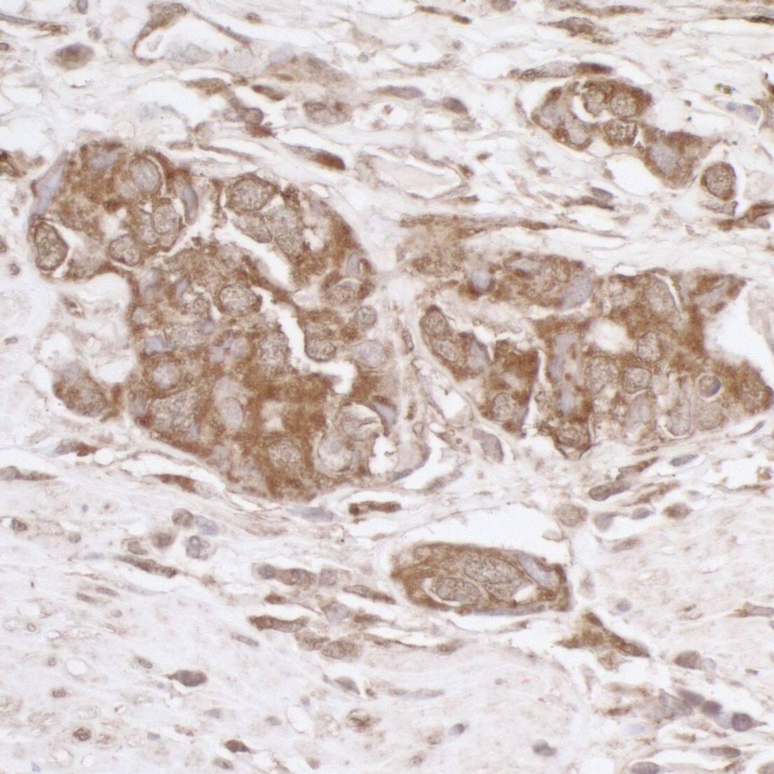 Immunohistochemistry;TRAP1 Antibody[NBP3-30427]Detection of human TRAP1/HSP75 by immunohistochemistry. Sample: FFPE section of human colon carcinoma. Antibody: Affinity purified rabbit anti-TRAP1/HSP75  used at a dilution of 1:1,000 . Detection: DAB