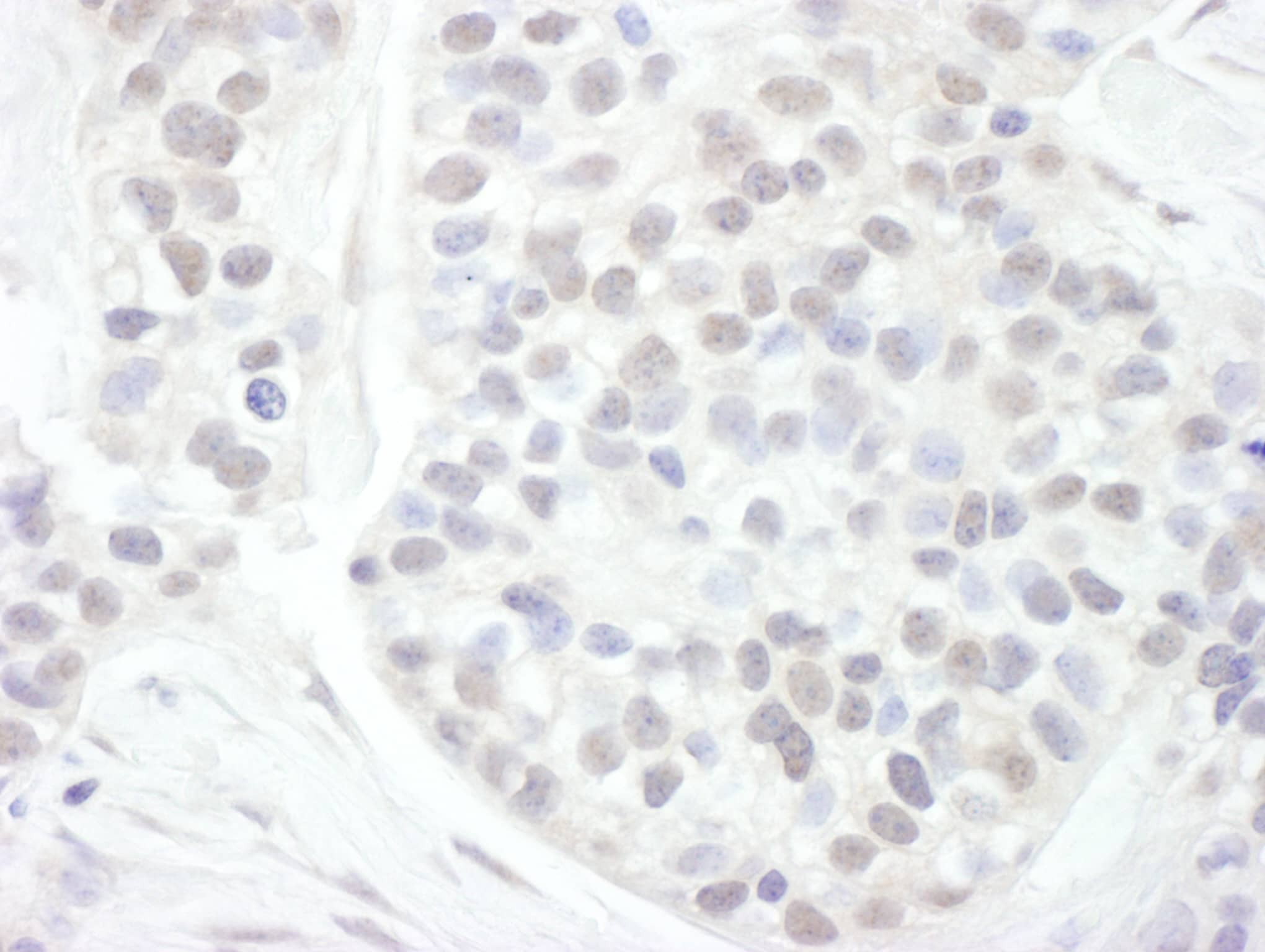 Immunohistochemistry:[NBP3-30429]-Detection of human Cyclin T1 by immunohistochemistry. Sample: FFPE section of human breast carcinoma. Antibody: Affinity purified rabbit anti-Cyclin T1 used at a dilution of 1: 200. Detection: DAB