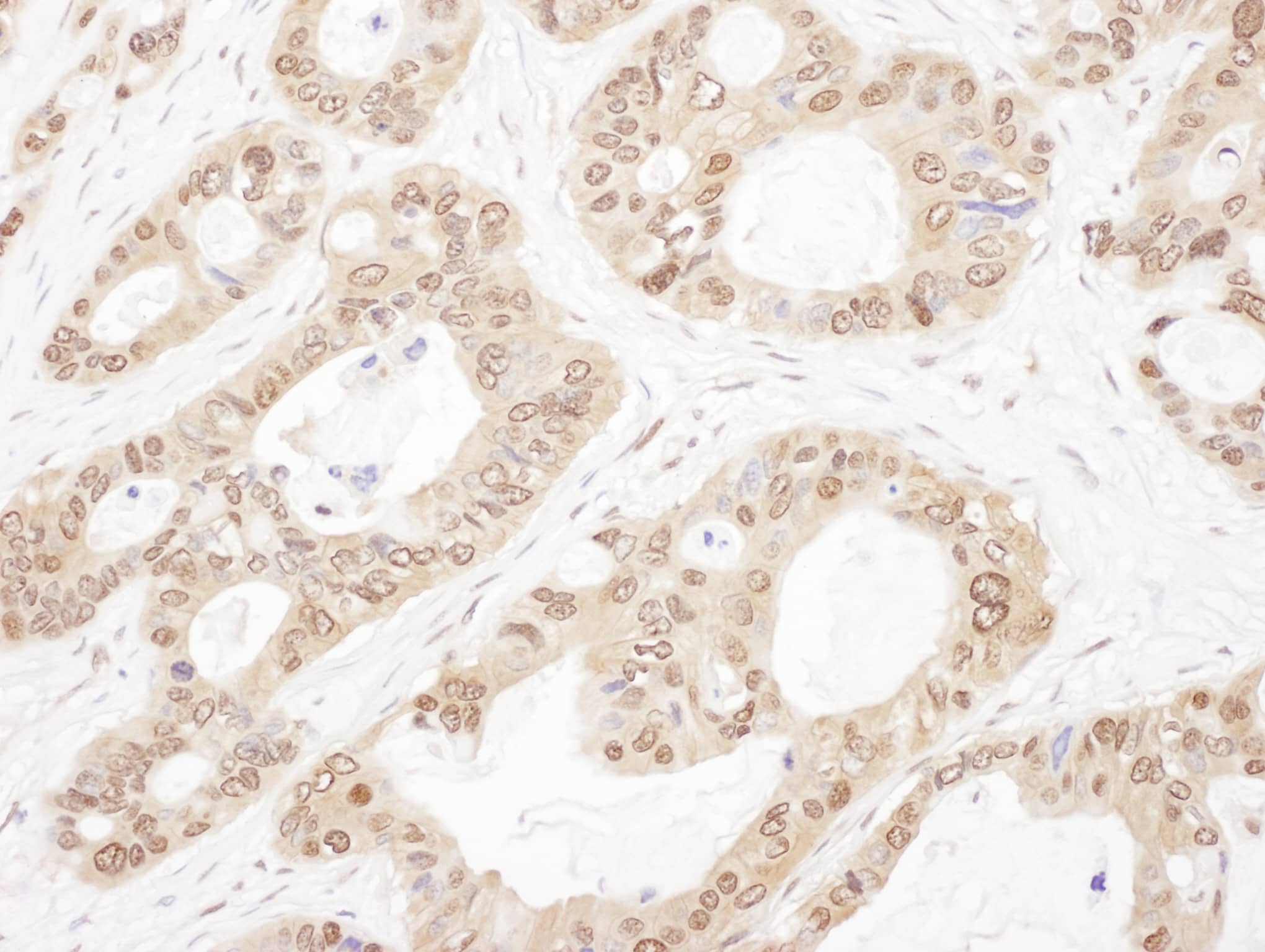 Immunohistochemistry;Zeta Opioid Receptor Antibody[NBP3-30428]Detection of human OGFR by immunohistochemistry. Sample: FFPE section of human ovarian carcinoma. Antibody: Affinity purified rabbit anti-OGFR  used at a dilution of 1:1,000 . Detection: DAB