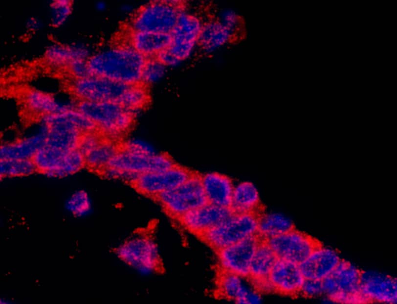 Immunohistochemistry:[NBP3-30452]-Detection of human CASC3 by immunohistochemistry. Sample: FFPE section of human ovarian carcinoma. Antibody: Affinity purified rabbit anti-CASC3 used at a dilution of 1: 200. Detection: DAB