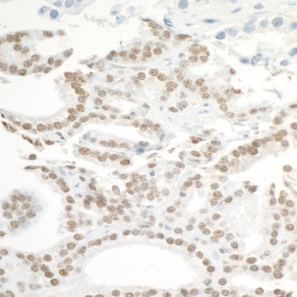 Immunohistochemistry:[NBP3-30453]-Detection of human BRD3 by immunohistochemistry. Sample: FFPE section of human prostate carcinoma. Antibody: Affinity purified rabbit anti-BRD3 used at a dilution of 1: 200. Detection: DAB