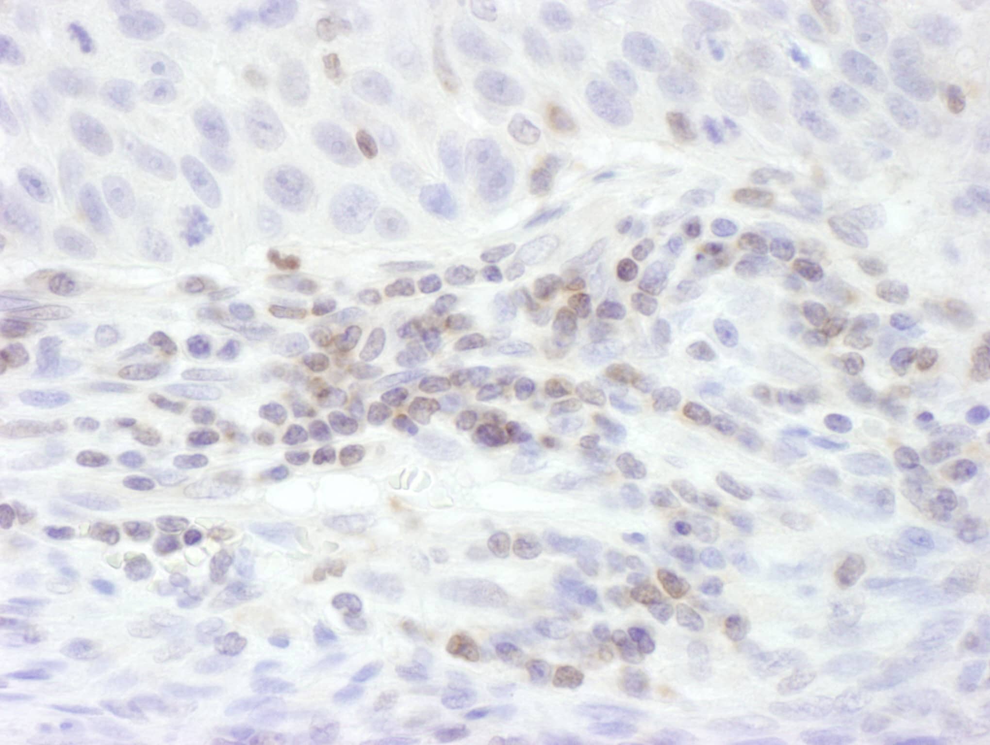 Immunohistochemistry:[NBP3-30495]-Detection of human STAT5b by immunohistochemistry. Sample: FFPE section of human lung carcinoma. Antibody: Affinity purified rabbit anti-STAT5b used at a dilution of 1: 200. Detection: DAB