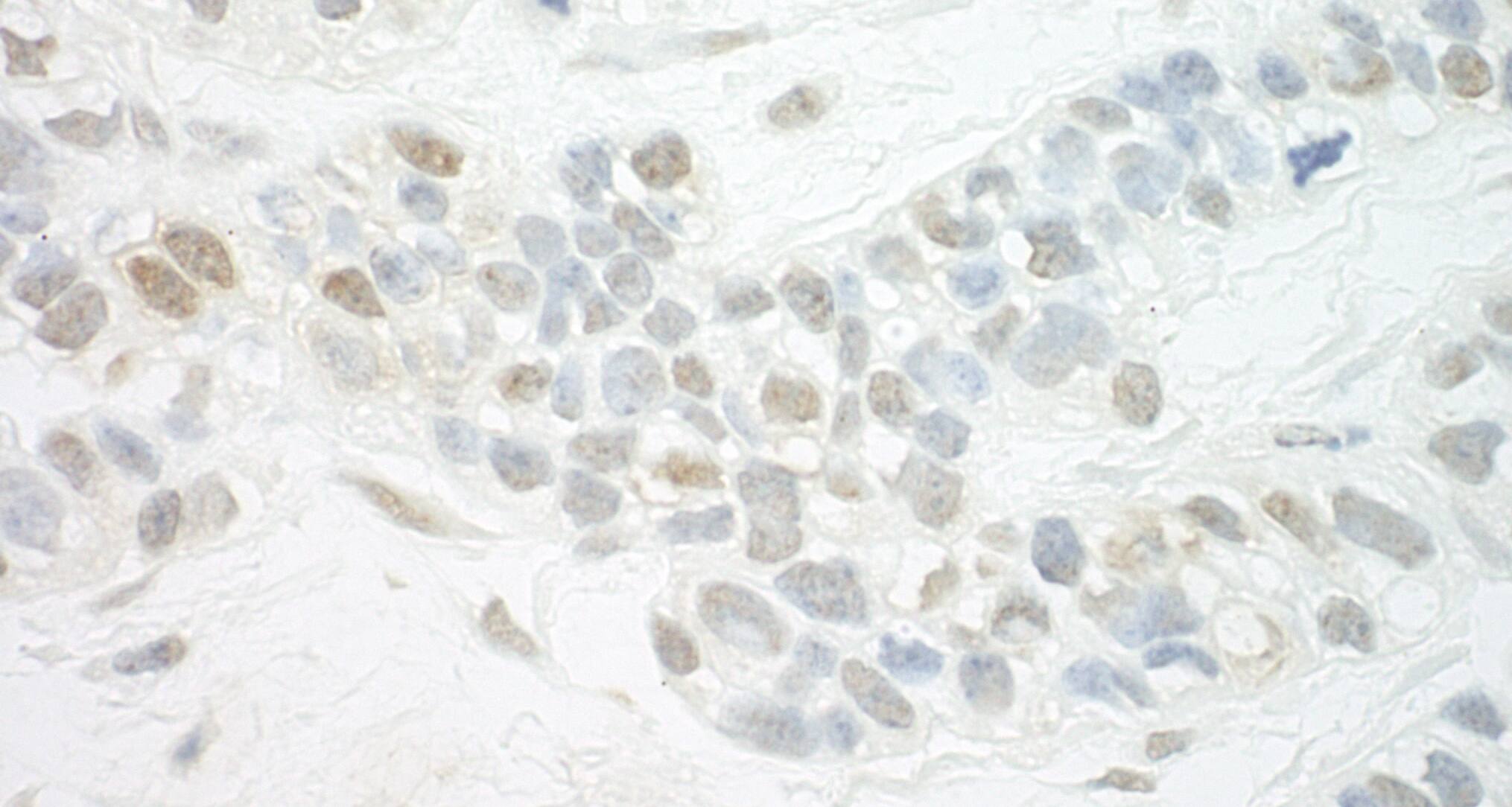 Immunohistochemistry;THRAP2 Antibody[NBP3-30475]Detection of human MED13L by immunohistochemistry. Sample: FFPE section of human breast carcinoma. Antibody: Affinity purified rabbit anti-MED13L  used at a dilution of 1:1,000 . Detection: DAB