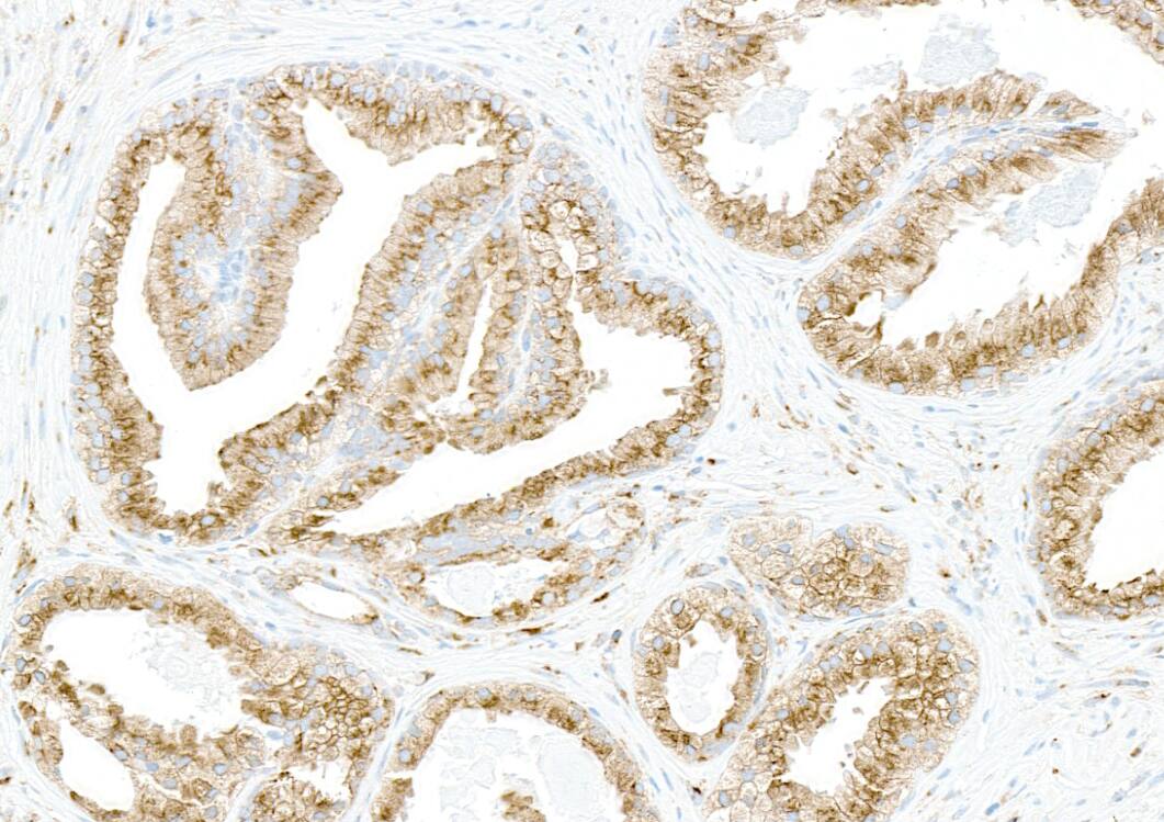 Immunohistochemistry;COPB2 Antibody[NBP3-30548]Detection of human COPB2 by immunohistochemistry. Samples: FFPE section of human prostate carcinoma. Antibody: Affinity purified rabbit anti-COPB2  used at a dilution of 1:5,000 . Detection: DAB