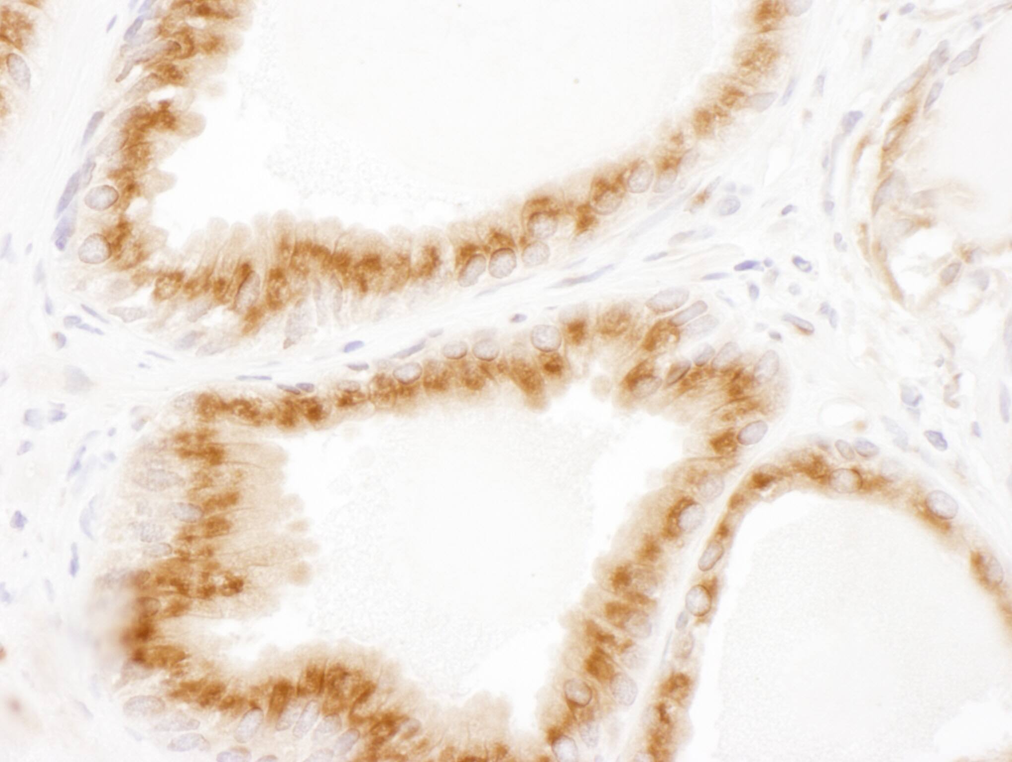 Immunohistochemistry;VDP p115 Antibody[NBP3-30572]Detection of human p115 by immunohistochemistry. Sample: FFPE section of human prostate carcinoma. Antibody: Affinity purified rabbit anti-p115  used at a dilution of 1:1,000 . Detection: DAB