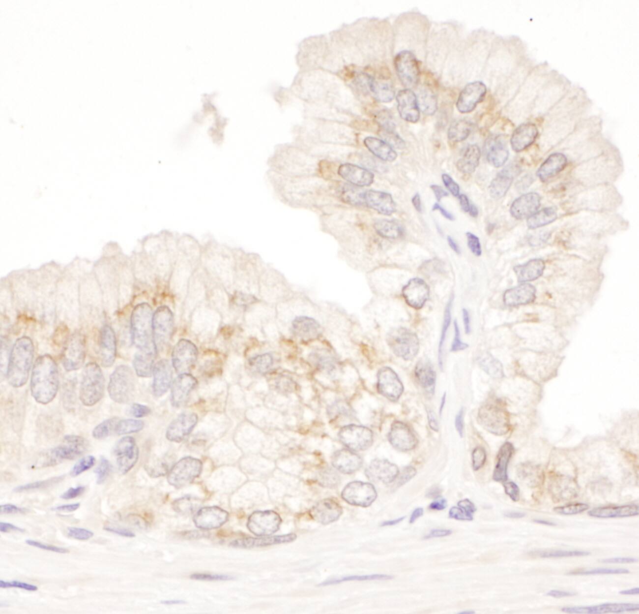 Immunohistochemistry:[NBP3-30575]-Detection of human GM130 by immunohistochemistry. Sample: FFPE section of human prostate carcinoma. Antibody: Affinity purified rabbit anti-GM130 used at a dilution of 1: 200. Detection: DAB. Counterstain: hematoxylin.