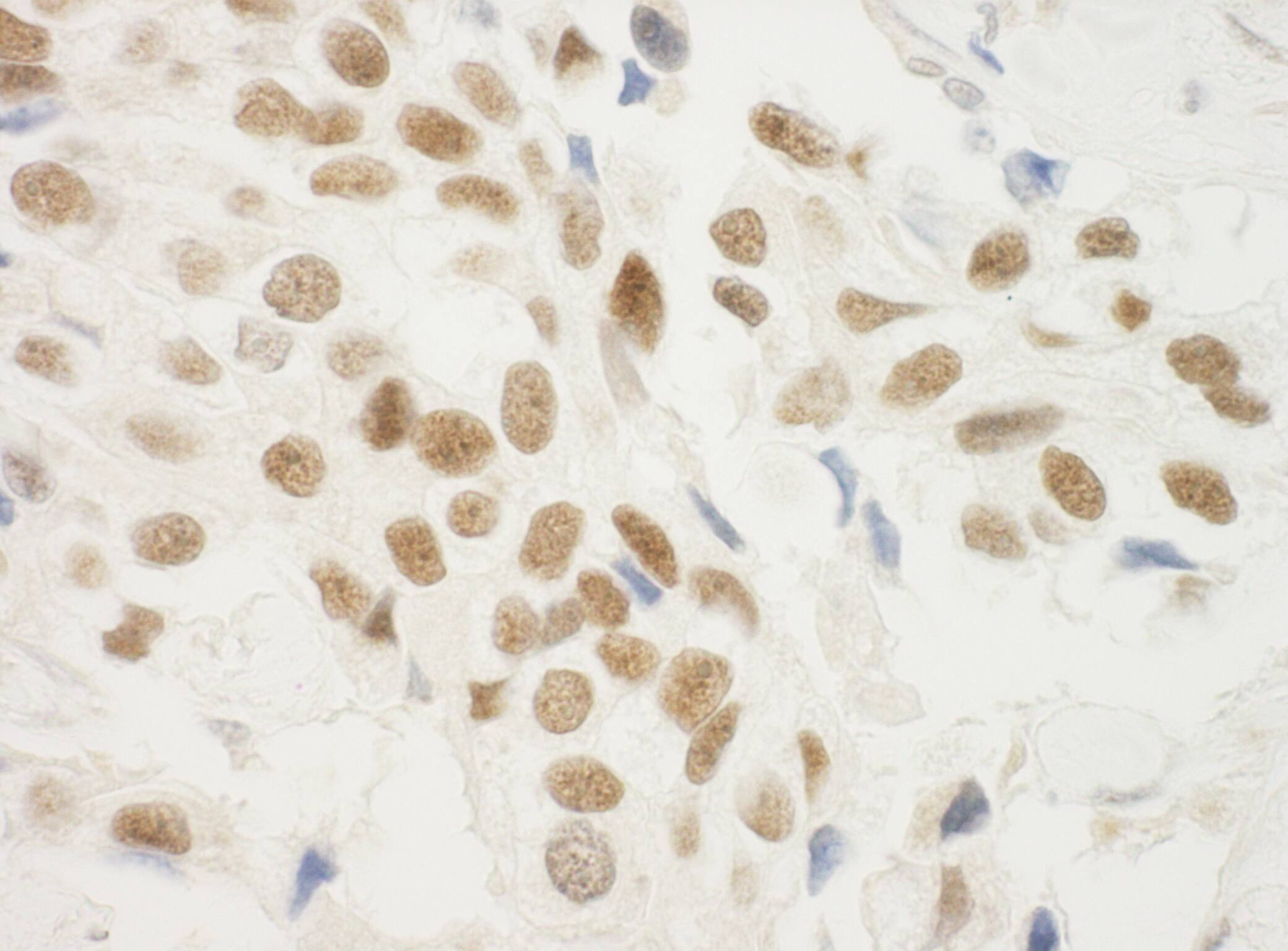 Immunohistochemistry:[NBP3-30647]-Detection of human ZNF768 by immunohistochemistry. Sample: FFPE section of human breast carcinoma. Antibody: Affinity purified rabbit anti-ZNF768 used at a dilution of 1: 200. Detection: DAB