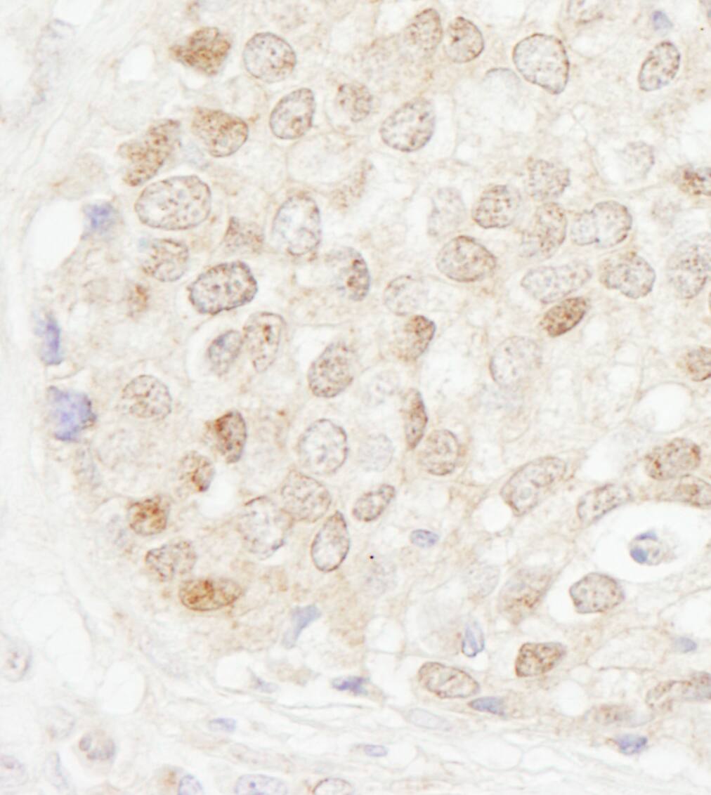 Immunohistochemistry:[NBP3-30657]-Detection of human MBD4 by immunohistochemistry. Sample: FFPE section of human breast carcinoma. Antibody: Affinity purified rabbit anti-MBD4 used at a dilution of 1: 200. Detection: DAB