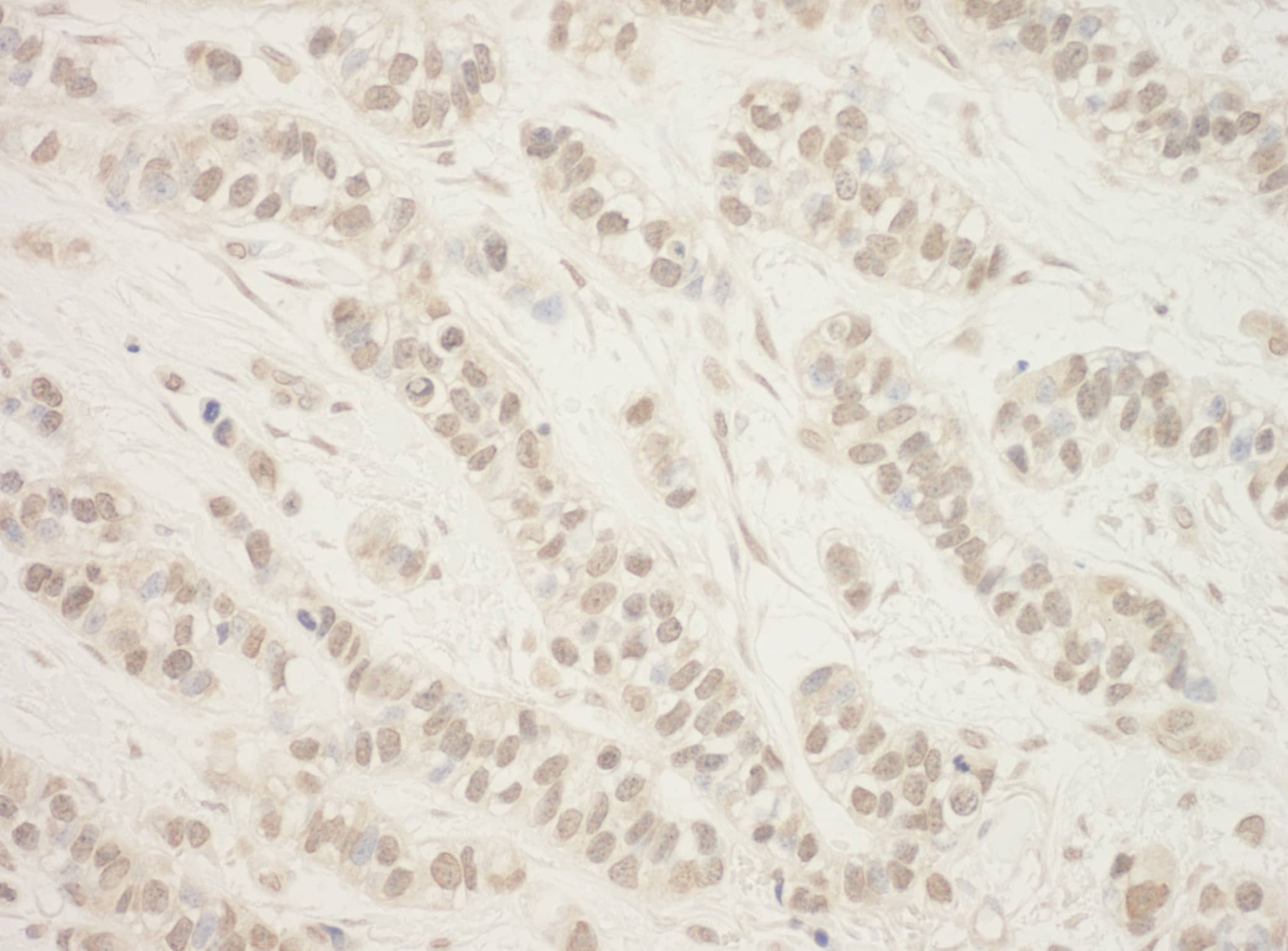 Immunohistochemistry;Folliculin Antibody[NBP3-30574]Detection of human BHD by immunohistochemistry. Sample: FFPE section of human breast carcinoma. Antibody: Affinity purified rabbit anti-BHD  used at a dilution of 1:1,000 . Detection: DAB