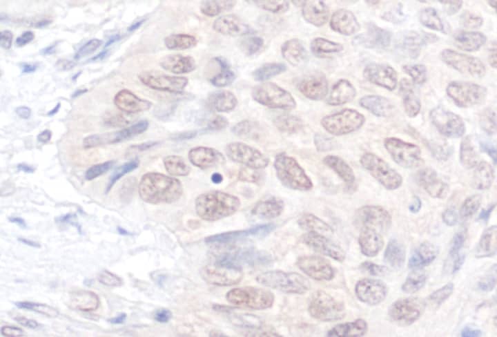 Immunohistochemistry;NEK7 Antibody[NBP3-30658]Detection of human NEK7 by immunohistochemistry. Sample: FFPE section of human lung carcinoma. Antibody: Affinity purified rabbit anti-NEK7  used at a dilution of 1:1,000 . Detection: DAB