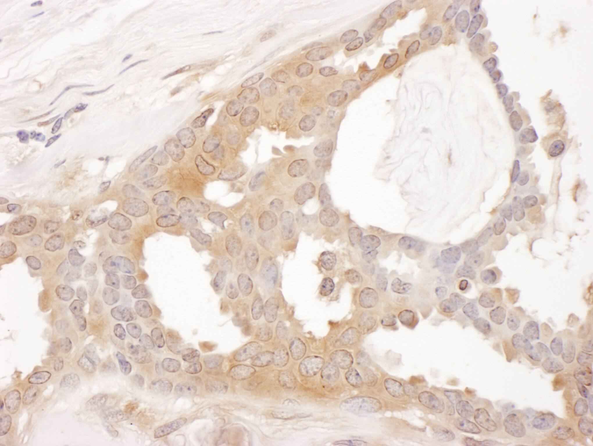 Immunohistochemistry:[NBP3-30679]-Detection of human CCT8 by immunohistochemistry. Sample: FFPE section of human breast carcinoma. Antibody: Affinity purified rabbit anti-CCT8 used at a dilution of 1: 200. Detection: DAB. Counterstain: hematoxylin.