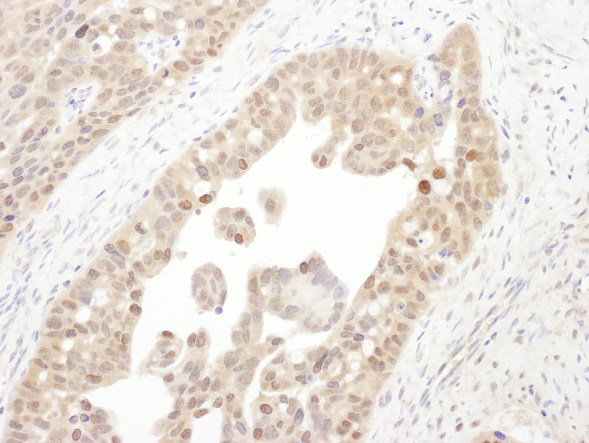 Immunohistochemistry;Tbp7 Antibody[NBP3-30704]Detection of human PSMC4 by immunohistochemistry. Sample: FFPE section of human ovarian carcinoma. Antibody: Affinity purified rabbit anti-PSMC4  used at a dilution of 1:1,000 . Detection: DAB