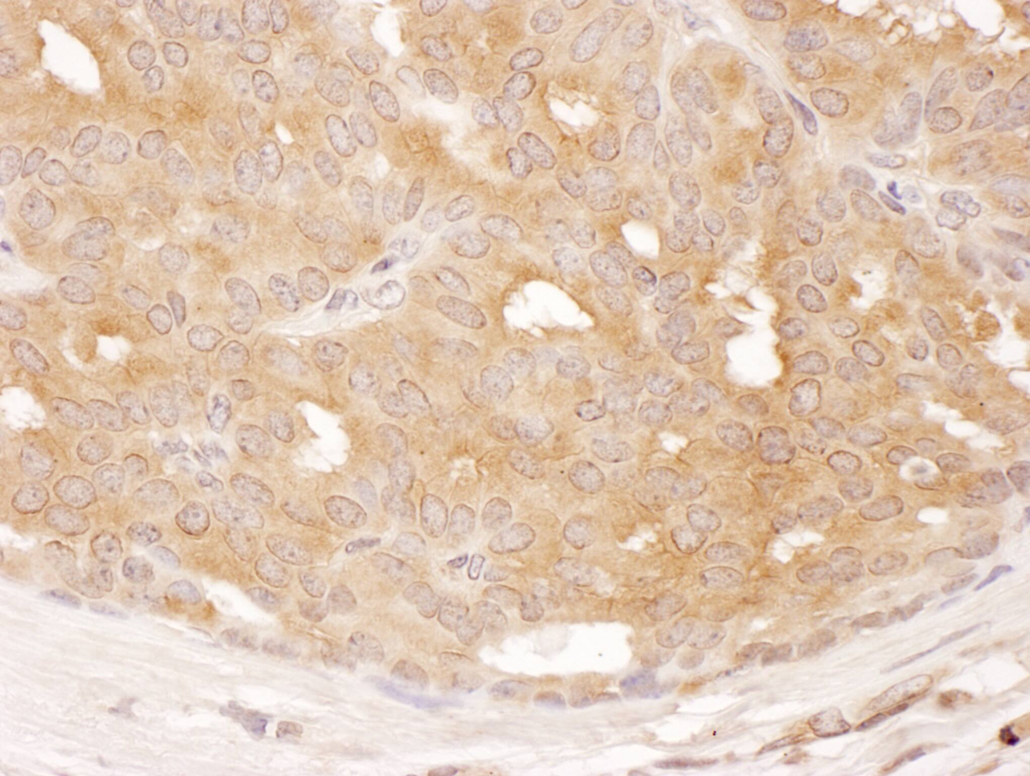 Immunohistochemistry;DYNC1LI1 Antibody[NBP3-30723]Detection of human DYNC1LI1 by immunohistochemistry. Sample: FFPE section of human breast carcinoma. Antibody: Affinity purified rabbit anti-DYNC1LI1  used at a dilution of 1:1,000 . Detection: DAB