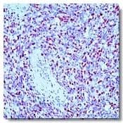 Immunohistochemistry-Paraffin: Myogenin Antibody (F12B) [NBP3-30816] -  Figure 1. Immunohistochemical staining using myogenin antibody on formalin fixed, paraffin embedded human rhabdomyosarcoma.