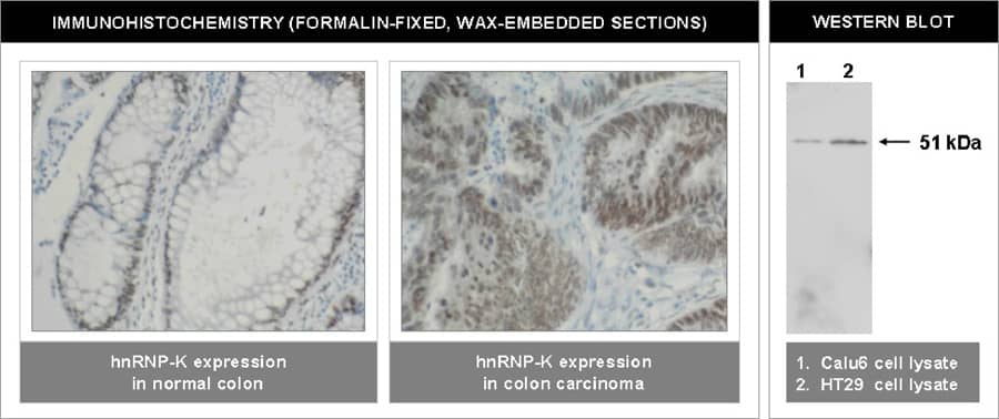 Immunohistochemistry: hnRNP K Antibody (F45 P9 C7) [NBP3-30893] -  Left and Center: Immunohistochemical staining of normal colon (left) and colon carcinoma (center) using hnRNP-K antibody (Cat. No. NBP3-30893).Right: Western blot using hnRNP-K antibody on Calu6 (1) and HT29 (2) cell lysates.