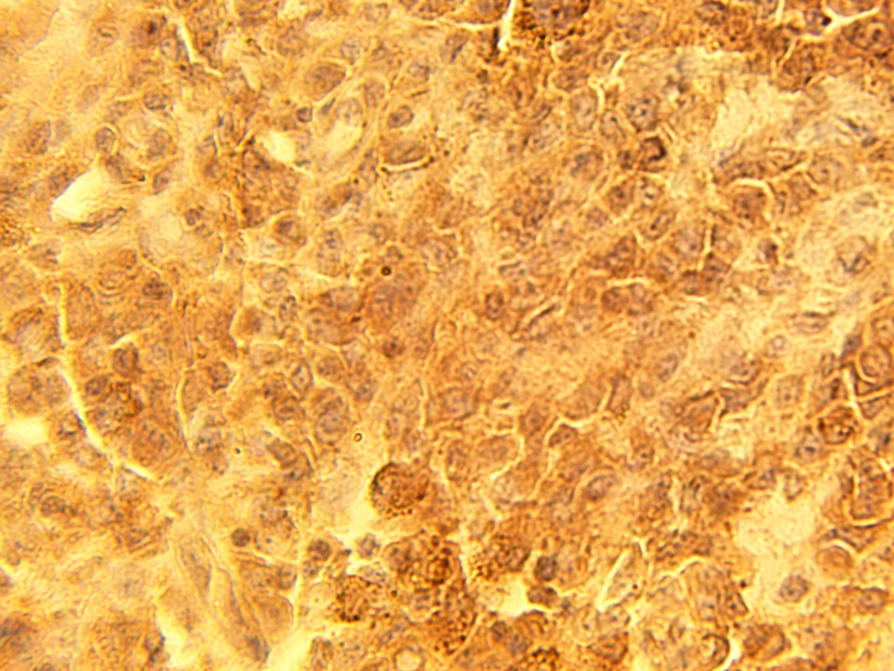 Immunohistochemistry: CSP Antibody [NBP3-30950] -  Immunohistochemical staining of human melanoma tissue using affinity purified CSP alpha antibody (Cat. No. NBP3-30950) at 15 ug/ml.