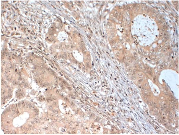 Immunohistochemistry-Paraffin: Dicer Antibody [NBP3-30965] -  Immunohistochemical staining of FFPE human colon carcinoma tissue using Dicer antibody (Cat. No. NBP3-30965). Antibody used at 1 ug/ml and visualized using DAB. Pathologists Comments: Cytoplasmic staining on mucous cells.