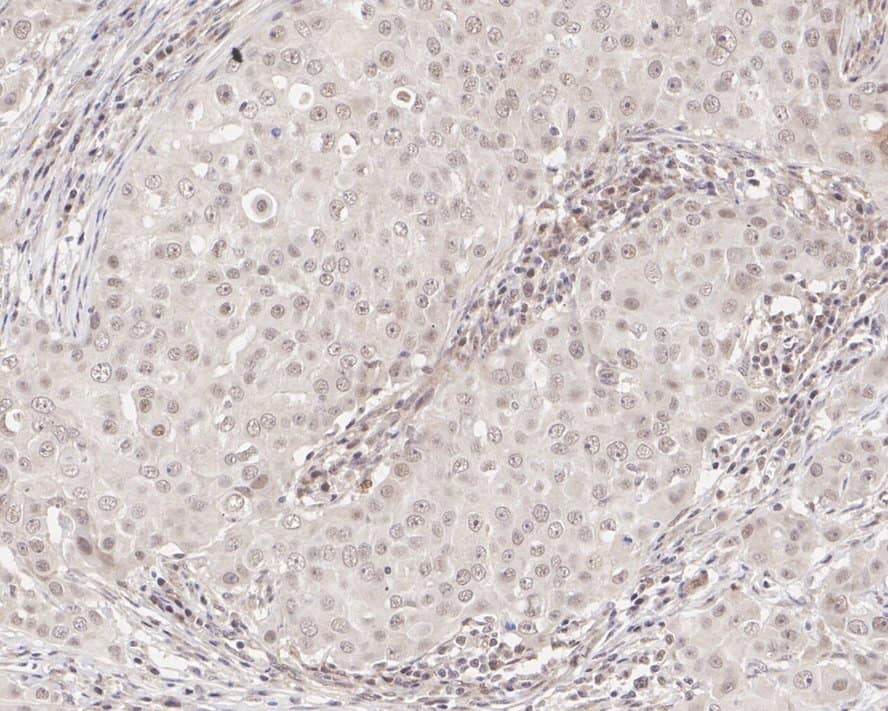 Immunohistochemistry: c-Abl Antibody (PSH04-08) [NBP3-31990] - Immunohistochemical analysis of paraffin-embedded human breast cancer tissue with Rabbit anti-c-Abl antibody (NBP3-31990) at 1/200 dilution. The section was pre-treated using heat mediated antigen retrieval with sodium citrate buffer (pH 6.0) for 2 minutes. The tissues were blocked in 1% BSA for 20 minutes at room temperature, washed with ddH2O and PBS, and then probed with the primary antibody (NBP3-31990) at 1/200 dilution for 1 hour at room temperature. The detection was performed using an HRP conjugated compact polymer system. DAB was used as the chromogen. Tissues were counterstained with hematoxylin and mounted with DPX.