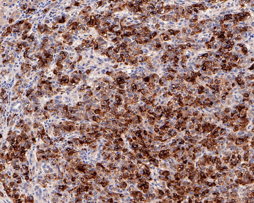 Immunohistochemistry: alpha-Fetoprotein/AFP Antibody (PD00-71) [NBP3-32008] - Immunohistochemical analysis of paraffin-embedded human liver carcinoma tissue with Rabbit anti-alpha-Fetoprotein/AFP antibody (NBP3-32008) at 1/200 dilution. The section was pre-treated using heat mediated antigen retrieval with Tris-EDTA buffer (pH 9.0) for 20 minutes. The tissues were blocked in 1% BSA for 20 minutes at room temperature, washed with ddH2O and PBS, and then probed with the primary antibody (NBP3-32008) at 1/200 dilution for 1 hour at room temperature. The detection was performed using an HRP conjugated compact polymer system. DAB was used as the chromogen. Tissues were counterstained with hematoxylin and mounted with DPX.