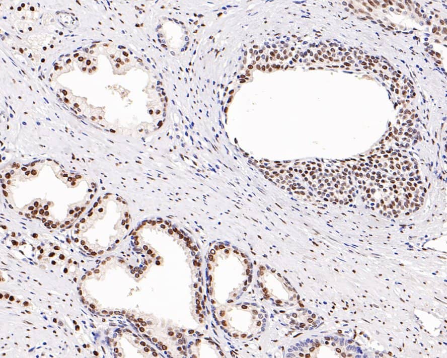 Immunohistochemistry: Androgen R/NR3C4 Antibody (PO00-29) [NBP3-32035] - Immunohistochemical analysis of paraffin-embedded human prostate carcinoma tissue with Rabbit anti-Androgen R/NR3C4 antibody (NBP3-32035) at 1/1,000 dilution. The section was pre-treated using heat mediated antigen retrieval with sodium citrate buffer (pH 6.0) for 2 minutes. The tissues were blocked in 1% BSA for 20 minutes at room temperature, washed with ddH2O and PBS, and then probed with the primary antibody (NBP3-32035) at 1/1,000 dilution for 1 hour at room temperature. The detection was performed using an HRP conjugated compact polymer system. DAB was used as the chromogen. Tissues were counterstained with hematoxylin and mounted with DPX.