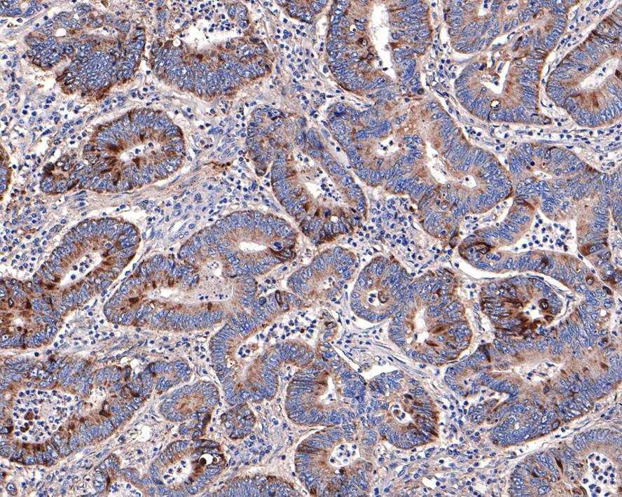 Immunohistochemistry: Annexin A7 Antibody (JE65-60) [NBP3-32038] - Immunohistochemical analysis of paraffin-embedded human colon carcinoma tissue with Rabbit anti-Annexin A7 antibody (NBP3-32038) at 1/100 dilution. The section was pre-treated using heat mediated antigen retrieval with Tris-EDTA buffer (pH 9.0) for 20 minutes. The tissues were blocked in 1% BSA for 20 minutes at room temperature, washed with ddH2O and PBS, and then probed with the primary antibody (NBP3-32038) at 1/100 dilution for 1 hour at room temperature. The detection was performed using an HRP conjugated compact polymer system. DAB was used as the chromogen. Tissues were counterstained with hematoxylin and mounted with DPX.