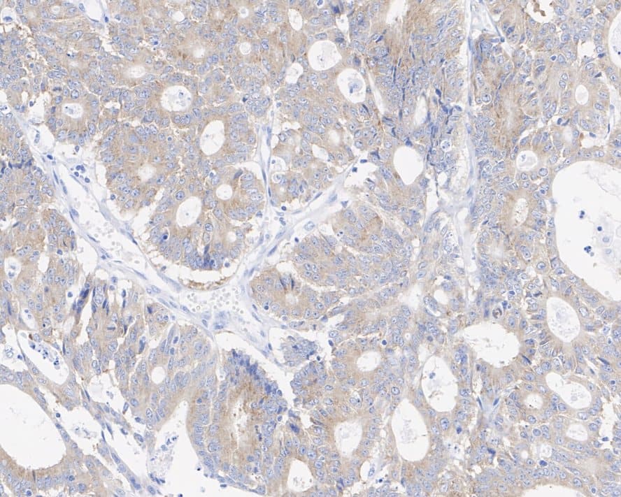 Immunohistochemistry: Axin-1 Antibody (PSH03-00) [NBP3-32064] - Immunohistochemical analysis of paraffin-embedded human colon cancer tissue with Rabbit anti-Axin-1 antibody (NBP3-32064) at 1/2,000 dilution. The section was pre-treated using heat mediated antigen retrieval with sodium citrate buffer (pH 6.0) for 2 minutes. The tissues were blocked in 1% BSA for 20 minutes at room temperature, washed with ddH2O and PBS, and then probed with the primary antibody (NBP3-32064) at 1/2,000 dilution for 1 hour at room temperature. The detection was performed using an HRP conjugated compact polymer system. DAB was used as the chromogen. Tissues were counterstained with hematoxylin and mounted with DPX.