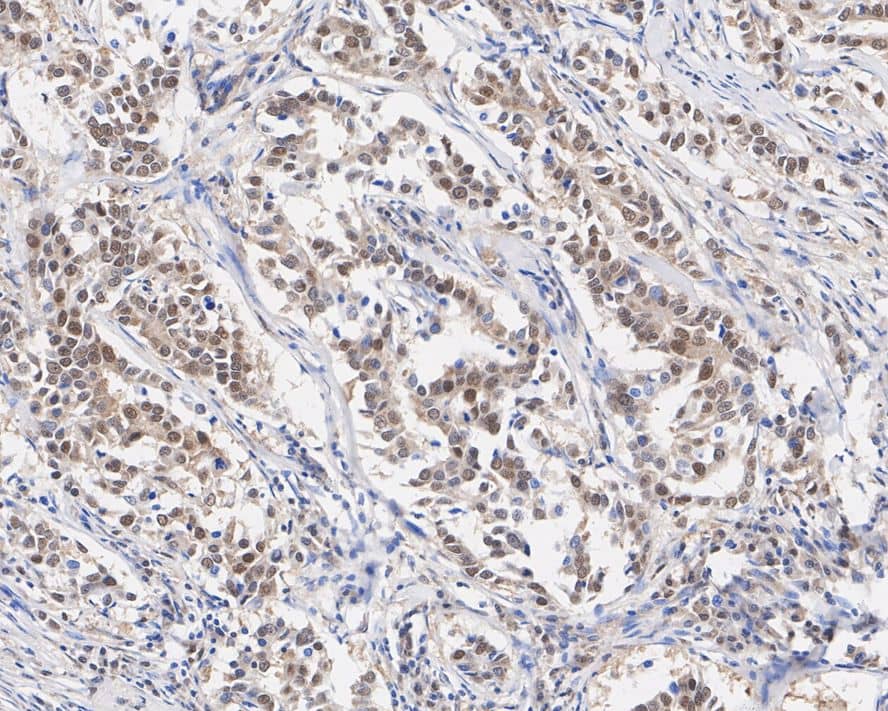 Immunohistochemistry: Bag-1 Antibody (JE63-22) [NBP3-32068] - Immunohistochemical analysis of paraffin-embedded human breast cancer tissue with Rabbit anti-Bag-1 antibody (NBP3-32068) at 1/500 dilution. The section was pre-treated using heat mediated antigen retrieval with sodium citrate buffer (pH 6.0) for 2 minutes. The tissues were blocked in 1% BSA for 20 minutes at room temperature, washed with ddH2O and PBS, and then probed with the primary antibody (NBP3-32068) at 1/500 dilution for 1 hour at room temperature. The detection was performed using an HRP conjugated compact polymer system. DAB was used as the chromogen. Tissues were counterstained with hematoxylin and mounted with DPX.