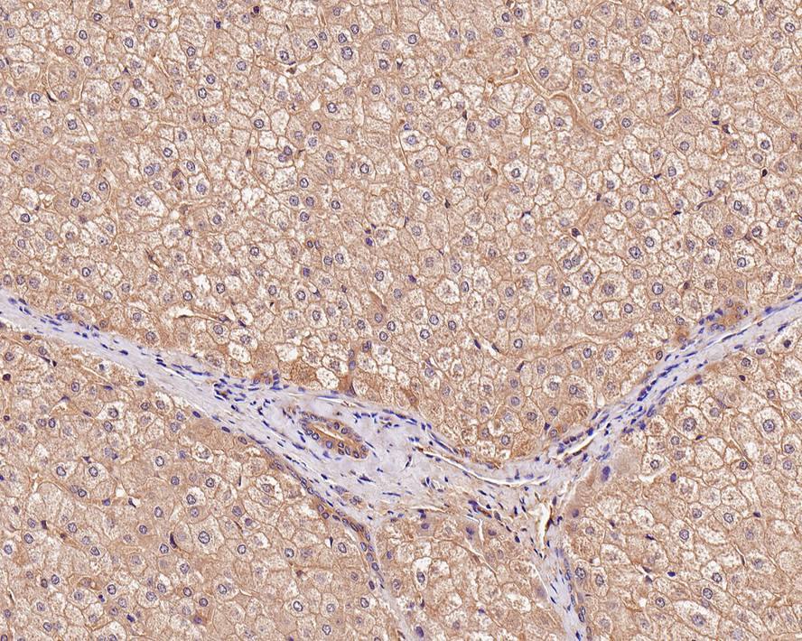 Immunohistochemistry: Bax Antibody (PSH0-20) [NBP3-32069] - Immunohistochemical analysis of paraffin-embedded human liver carcinoma tissue with Mouse anti-Bax antibody (NBP3-32069) at 1/200 dilution. The section was pre-treated using heat mediated antigen retrieval with Tris-EDTA buffer (pH 9.0) for 20 minutes. The tissues were blocked in 1% BSA for 20 minutes at room temperature, washed with ddH2O and PBS, and then probed with the primary antibody (NBP3-32069) at 1/200 dilution for 1 hour at room temperature. The detection was performed using an HRP conjugated compact polymer system. DAB was used as the chromogen. Tissues were counterstained with hematoxylin and mounted with DPX.