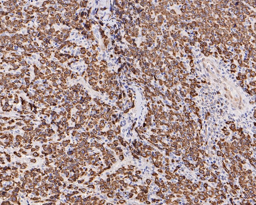 Immunohistochemistry: Bcl-2 Antibody (PD01-41) [NBP3-32073] - Immunohistochemical analysis of paraffin-embedded human B-cell lymphoma tissue with Rabbit anti-Bcl-2 antibody (NBP3-32073) at 1/1,000 dilution. The section was pre-treated using heat mediated antigen retrieval with Tris-EDTA buffer (pH 9.0) for 20 minutes. The tissues were blocked in 1% BSA for 20 minutes at room temperature, washed with ddH2O and PBS, and then probed with the primary antibody (NBP3-32073) at 1/1,000 dilution for 1 hour at room temperature. The detection was performed using an HRP conjugated compact polymer system. DAB was used as the chromogen. Tissues were counterstained with hematoxylin and mounted with DPX.