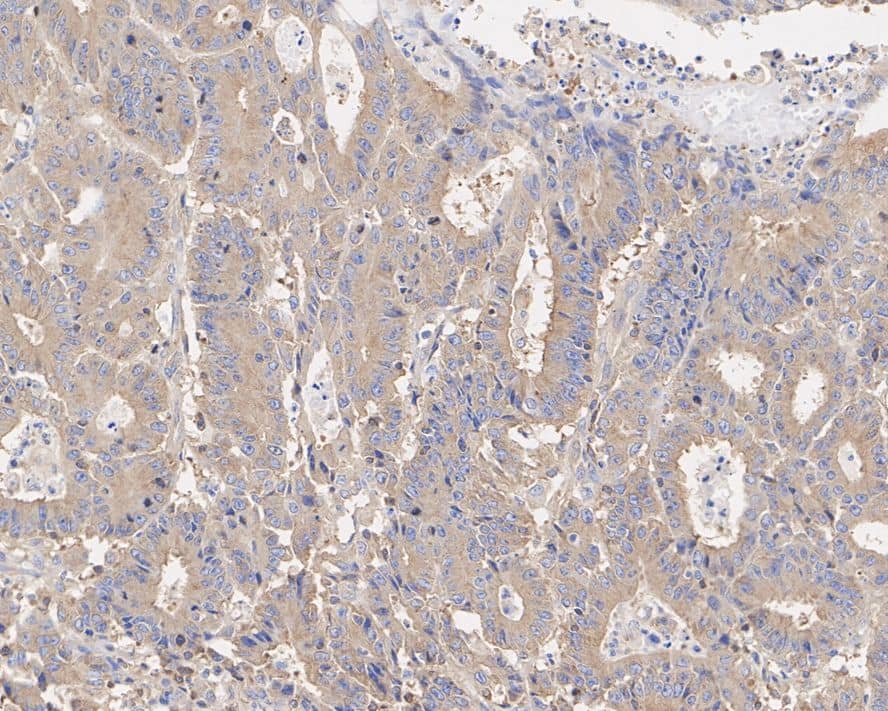 Immunohistochemistry: beta Tubulin Antibody (A1-A4-R) [NBP3-32081] - Immunohistochemical analysis of paraffin-embedded human colon cancer tissue with Mouse anti-beta Tubulin antibody (NBP3-32081) at 1/10,000 dilution. The section was pre-treated using heat mediated antigen retrieval with Tris-EDTA buffer (pH 9.0) for 20 minutes. The tissues were blocked in 1% BSA for 20 minutes at room temperature, washed with ddH2O and PBS, and then probed with the primary antibody (NBP3-32081) at 1/10,000 dilution for 1 hour at room temperature. The detection was performed using an HRP conjugated compact polymer system. DAB was used as the chromogen. Tissues were counterstained with hematoxylin and mounted with DPX.