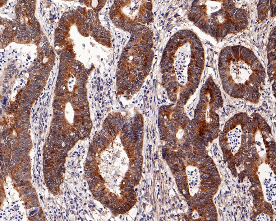 Immunohistochemistry: URI Antibody (PD00-48) [NBP3-32096] - Immunohistochemical analysis of paraffin-embedded human colon carcinoma tissue with Rabbit anti-URI antibody (NBP3-32096) at 1/1,000 dilution. The section was pre-treated using heat mediated antigen retrieval with sodium citrate buffer (pH 6.0) for 2 minutes. The tissues were blocked in 1% BSA for 20 minutes at room temperature, washed with ddH2O and PBS, and then probed with the primary antibody (NBP3-32096) at 1/1,000 dilution for 1 hour at room temperature. The detection was performed using an HRP conjugated compact polymer system. DAB was used as the chromogen. Tissues were counterstained with hematoxylin and mounted with DPX.