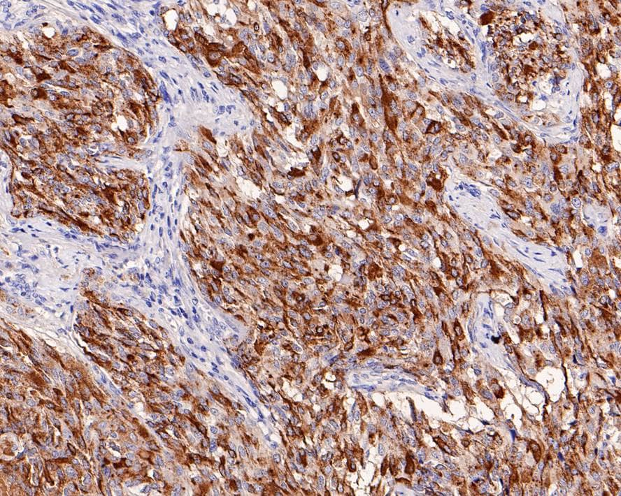 Immunohistochemistry: Calcitonin Antibody (PD00-46) [NBP3-32101] - Immunohistochemical analysis of paraffin-embedded human medullary thyroid carcinoma tissue with Rabbit anti-Calcitonin antibody (NBP3-32101) at 1/20,000 dilution. The section was pre-treated using heat mediated antigen retrieval with Tris-EDTA buffer (pH 9.0) for 20 minutes. The tissues were blocked in 1% BSA for 20 minutes at room temperature, washed with ddH2O and PBS, and then probed with the primary antibody (NBP3-32101) at 1/20,000 dilution for 1 hour at room temperature. The detection was performed using an HRP conjugated compact polymer system. DAB was used as the chromogen. Tissues were counterstained with hematoxylin and mounted with DPX.