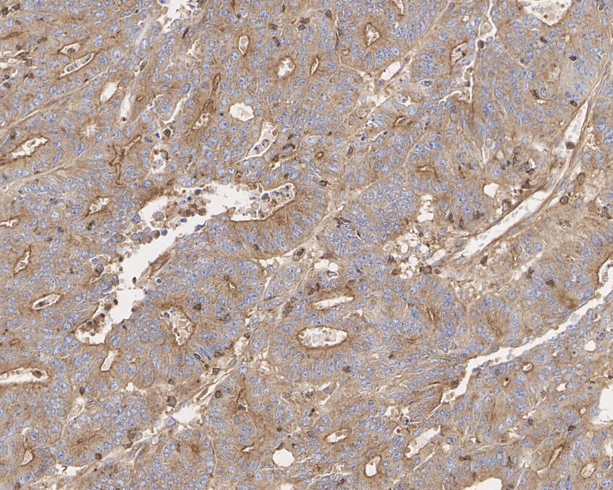 Immunohistochemistry: CAPZA1 Antibody (A2E7-R) [NBP3-32104] - Immunohistochemical analysis of paraffin-embedded human colon cancer tissue with Mouse anti-CAPZA1 antibody (NBP3-32104) at 1/1,000 dilution. The section was pre-treated using heat mediated antigen retrieval with Tris-EDTA buffer (pH 9.0) for 20 minutes. The tissues were blocked in 1% BSA for 20 minutes at room temperature, washed with ddH2O and PBS, and then probed with the primary antibody (NBP3-32104) at 1/1,000 dilution for 1 hour at room temperature. The detection was performed using an HRP conjugated compact polymer system. DAB was used as the chromogen. Tissues were counterstained with hematoxylin and mounted with DPX.