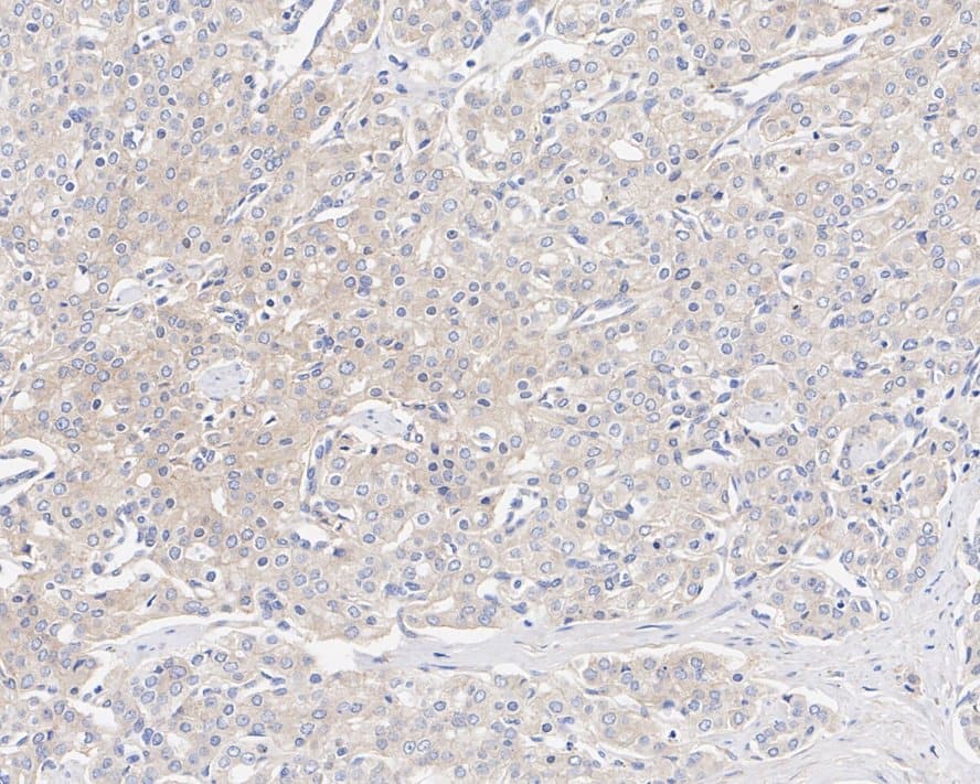 Immunohistochemistry: CASK Antibody (A1C5-R) [NBP3-32108] - Immunohistochemical analysis of paraffin-embedded human prostate cancer tissue with Mouse anti-CASK antibody (NBP3-32108) at 1/500 dilution. The section was pre-treated using heat mediated antigen retrieval with Tris-EDTA buffer (pH 9.0) for 20 minutes. The tissues were blocked in 1% BSA for 20 minutes at room temperature, washed with ddH2O and PBS, and then probed with the primary antibody (NBP3-32108) at 1/500 dilution for 1 hour at room temperature. The detection was performed using an HRP conjugated compact polymer system. DAB was used as the chromogen. Tissues were counterstained with hematoxylin and mounted with DPX.