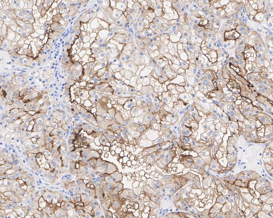 Immunohistochemistry: Neprilysin/CD10 Antibody (A1G3-R) [NBP3-32118] - Immunohistochemical analysis of paraffin-embedded human renal clear cell carcinoma tissue with Mouse anti-Neprilysin/CD10 antibody (NBP3-32118) at 1/200 dilution. The section was pre-treated using heat mediated antigen retrieval with Tris-EDTA buffer (pH 9.0) for 20 minutes. The tissues were blocked in 1% BSA for 20 minutes at room temperature, washed with ddH2O and PBS, and then probed with the primary antibody (NBP3-32118) at 1/200 dilution for 1 hour at room temperature. The detection was performed using an HRP conjugated compact polymer system. DAB was used as the chromogen. Tissues were counterstained with hematoxylin and mounted with DPX.