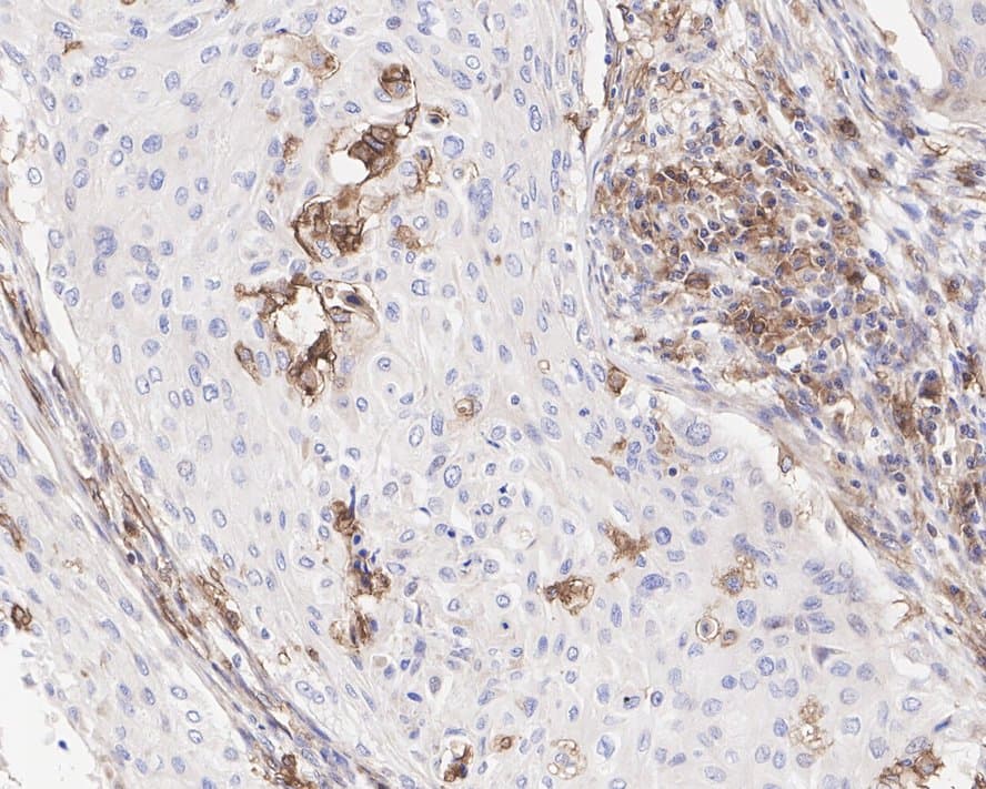 Immunohistochemistry: CD11b Antibody (PSH03-96) [NBP3-32121] - Immunohistochemical analysis of paraffin-embedded human cervical cancer tissue with Rabbit anti-CD11b antibody (NBP3-32121) at 1/5,000 dilution. The section was pre-treated using heat mediated antigen retrieval with Tris-EDTA buffer (pH 9.0) for 20 minutes. The tissues were blocked in 1% BSA for 20 minutes at room temperature, washed with ddH2O and PBS, and then probed with the primary antibody (NBP3-32121) at 1/5,000 dilution for 1 hour at room temperature. The detection was performed using an HRP conjugated compact polymer system. DAB was used as the chromogen. Tissues were counterstained with hematoxylin and mounted with DPX.