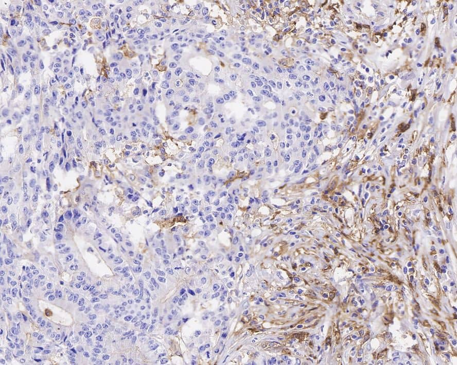 Immunohistochemistry: CD14 Antibody (PD01-63) [NBP3-32125] - Immunohistochemical analysis of paraffin-embedded human colon carcinoma tissue with Rabbit anti-CD14 antibody (NBP3-32125) at 1/1,000 dilution. The section was pre-treated using heat mediated antigen retrieval with Tris-EDTA buffer (pH 9.0) for 20 minutes. The tissues were blocked in 1% BSA for 20 minutes at room temperature, washed with ddH2O and PBS, and then probed with the primary antibody (NBP3-32125) at 1/1,000 dilution for 1 hour at room temperature. The detection was performed using an HRP conjugated compact polymer system. DAB was used as the chromogen. Tissues were counterstained with hematoxylin and mounted with DPX.