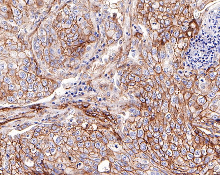 Immunohistochemistry: B7-H3/CD276 Antibody (PD00-36) [NBP3-32138] - Immunohistochemical analysis of paraffin-embedded human lung squamous cell carcinoma tissue with Rabbit anti-B7-H3/CD276 antibody (NBP3-32138) at 1/5,000 dilution. The section was pre-treated using heat mediated antigen retrieval with Tris-EDTA buffer (pH 9.0) for 20 minutes. The tissues were blocked in 1% BSA for 20 minutes at room temperature, washed with ddH2O and PBS, and then probed with the primary antibody (NBP3-32138) at 1/5,000 dilution for 1 hour at room temperature. The detection was performed using an HRP conjugated compact polymer system. DAB was used as the chromogen. Tissues were counterstained with hematoxylin and mounted with DPX.