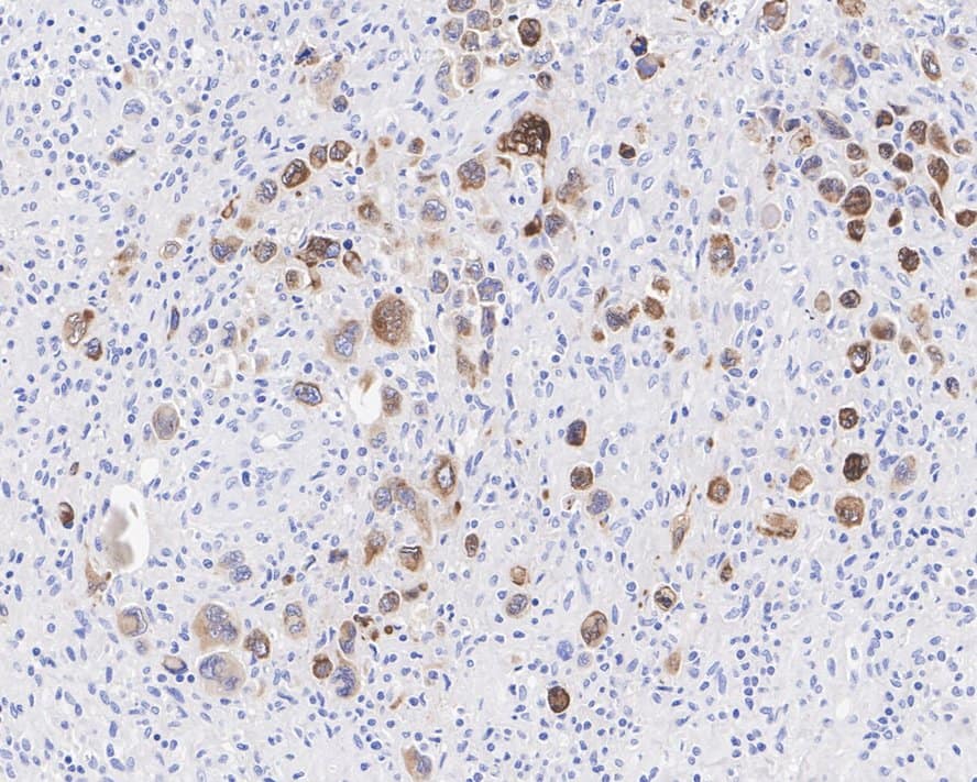 Immunohistochemistry: CD30/TNFRSF8 Antibody (PSH04-11) [NBP3-32143] - Immunohistochemical analysis of paraffin-embedded human anaplastic large cell lymphoma tissue with Rabbit anti-CD30/TNFRSF8 antibody (NBP3-32143) at 1/1,500 dilution. The section was pre-treated using heat mediated antigen retrieval with Tris-EDTA buffer (pH 9.0) for 20 minutes. The tissues were blocked in 1% BSA for 20 minutes at room temperature, washed with ddH2O and PBS, and then probed with the primary antibody (NBP3-32143) at 1/1,500 dilution for 1 hour at room temperature. The detection was performed using an HRP conjugated compact polymer system. DAB was used as the chromogen. Tissues were counterstained with hematoxylin and mounted with DPX.