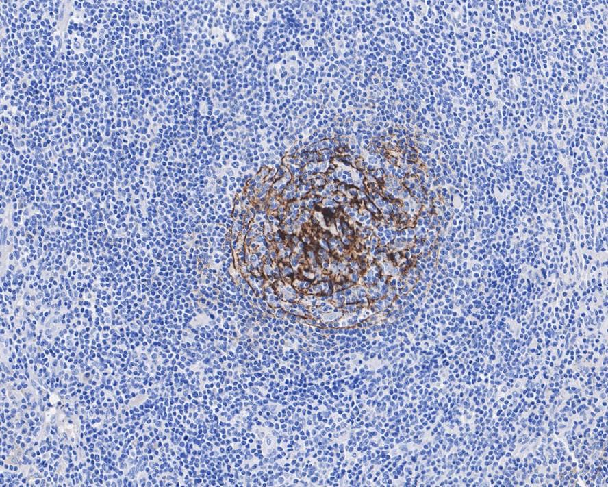 Immunohistochemistry: CD35 Antibody (A4F3-R) [NBP3-32149] - Immunohistochemical analysis of paraffin-embedded human Hodgkin lymphoma tissue with Mouse anti-CD35 antibody (NBP3-32149) at 1/1,000 dilution. The section was pre-treated using heat mediated antigen retrieval with Tris-EDTA buffer (pH 9.0) for 20 minutes. The tissues were blocked in 1% BSA for 20 minutes at room temperature, washed with ddH2O and PBS, and then probed with the primary antibody (NBP3-32149) at 1/1,000 dilution for 1 hour at room temperature. The detection was performed using an HRP conjugated compact polymer system. DAB was used as the chromogen. Tissues were counterstained with hematoxylin and mounted with DPX.