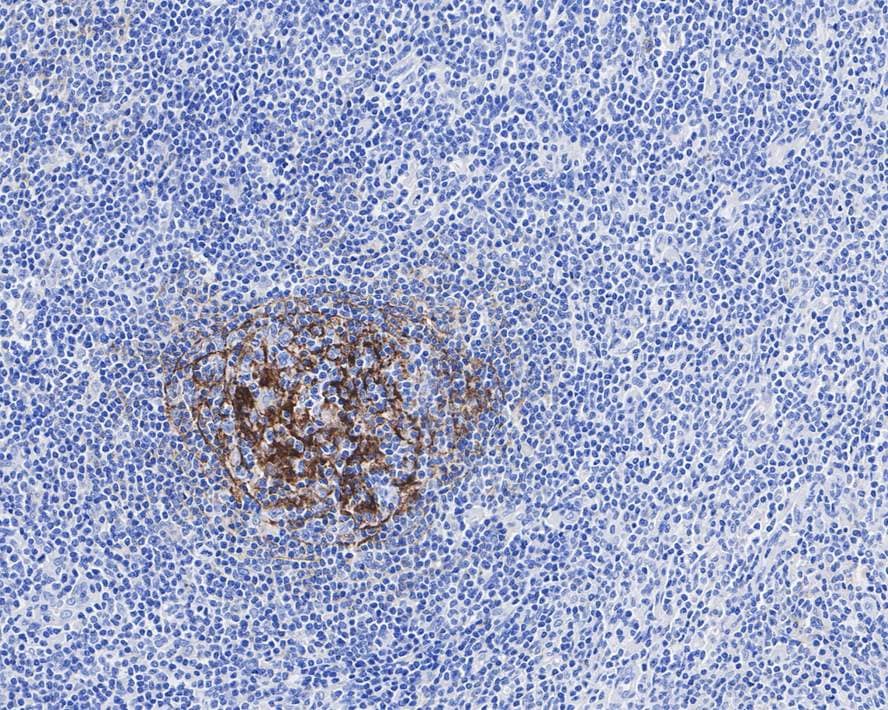 Immunohistochemistry: CD35 Antibody (A4G1-R) [NBP3-32150] - Immunohistochemical analysis of paraffin-embedded human hodgkin lymphoma tissue with Mouse anti-CD35 antibody (NBP3-32150) at 1/500 dilution. The section was pre-treated using heat mediated antigen retrieval with Tris-EDTA buffer (pH 9.0) for 20 minutes. The tissues were blocked in 1% BSA for 20 minutes at room temperature, washed with ddH2O and PBS, and then probed with the primary antibody (NBP3-32150) at 1/500 dilution for 1 hour at room temperature. The detection was performed using an HRP conjugated compact polymer system. DAB was used as the chromogen. Tissues were counterstained with hematoxylin and mounted with DPX.