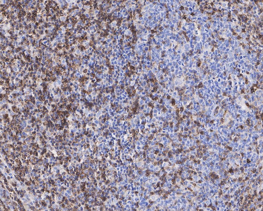 Immunohistochemistry: CD43/Sialophorin Antibody (A2F8-R) [NBP3-32154] - Immunohistochemical analysis of paraffin-embedded human B lymphocyte tumor tissue with Mouse anti-CD43/Sialophorin antibody (NBP3-32154) at 1/1,000 dilution. The section was pre-treated using heat mediated antigen retrieval with Tris-EDTA buffer (pH 9.0) for 20 minutes. The tissues were blocked in 1% BSA for 20 minutes at room temperature, washed with ddH2O and PBS, and then probed with the primary antibody (NBP3-32154) at 1/1,000 dilution for 1 hour at room temperature. The detection was performed using an HRP conjugated compact polymer system. DAB was used as the chromogen. Tissues were counterstained with hematoxylin and mounted with DPX.