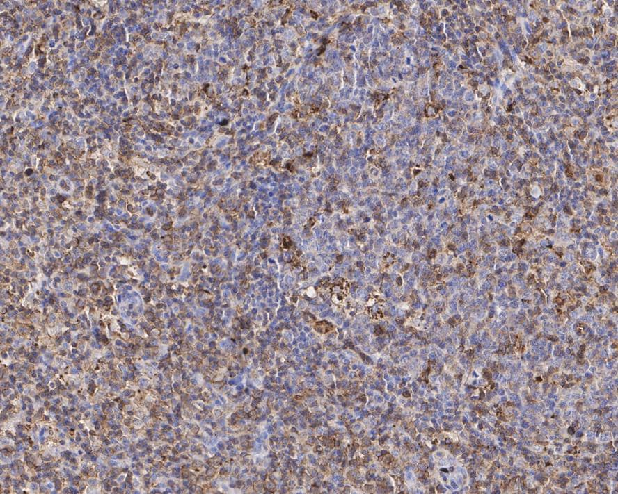 Immunohistochemistry: CD43/Sialophorin Antibody (PD01-28) [NBP3-32155] - Immunohistochemical analysis of paraffin-embedded human B-cell lymphoma tissue with Rabbit anti-CD43/Sialophorin antibody (NBP3-32155) at 1/5,000 dilution. The section was pre-treated using heat mediated antigen retrieval with Tris-EDTA buffer (pH 9.0) for 20 minutes. The tissues were blocked in 1% BSA for 20 minutes at room temperature, washed with ddH2O and PBS, and then probed with the primary antibody (NBP3-32155) at 1/5,000 dilution for 1 hour at room temperature. The detection was performed using an HRP conjugated compact polymer system. DAB was used as the chromogen. Tissues were counterstained with hematoxylin and mounted with DPX.